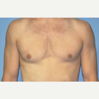 Bilateral Gynecomastia Correction after 2969813