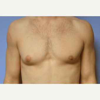 Bilateral Gynecomastia Correction before 2969813