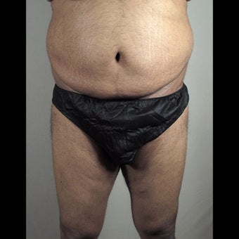 35-44 year old man treated for Thigh Lift after 1527868