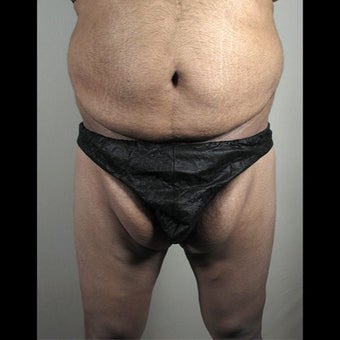 35-44 year old man treated for Thigh Lift before 1527868