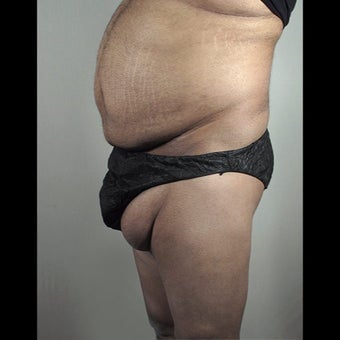 35-44 year old man treated for Thigh Lift 1527868