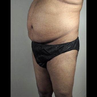 35-44 year old man treated for Thigh Lift 1527868