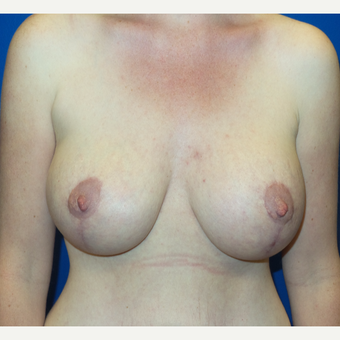 35-44 year old woman treated with Breast Lift after 3252693