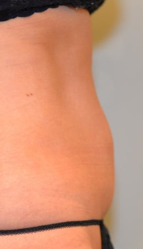 38 Year Old Woman for CoolSculpting 1394089