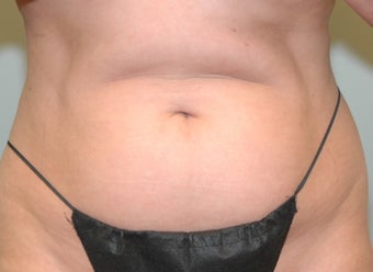 38 Year Old Woman for CoolSculpting before 1394089