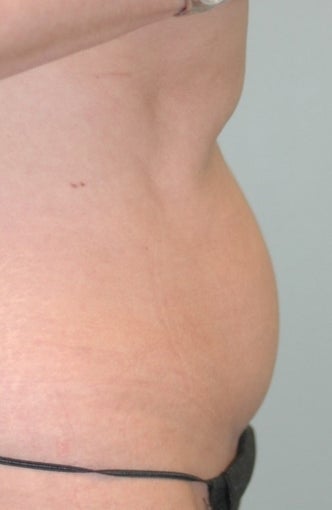 38 Year Old Woman for CoolSculpting 1394089