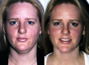 Neck Liposuction before 1182889