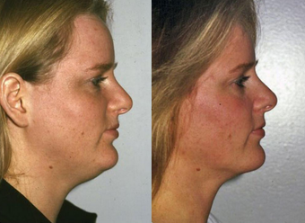 Neck Liposuction after 1182889