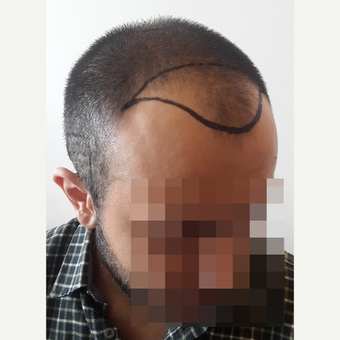 18-24 year old man treated with FUE Hair Transplant before 3729969