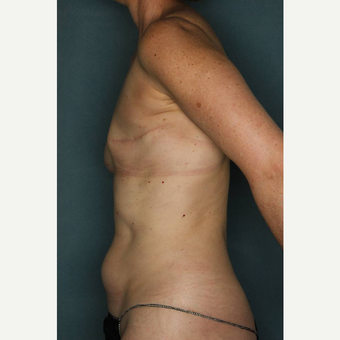 45-54 year old woman treated with Lumbar Artery Perforator Flap Breast Reconstruction before 3484854