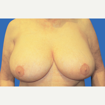55-64 year old woman treated with Breast Reduction after 3280913