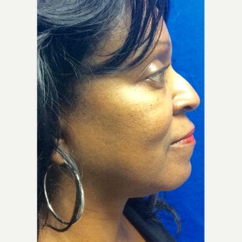 45-54 year old woman treated with Kybella after 2504009