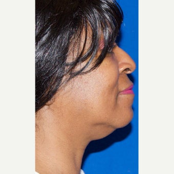 45-54 year old woman treated with Kybella before 2504009