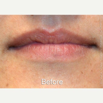 18-24 year old woman treated with Lip Augmentation with Juvederm Ultra XC before 1630783