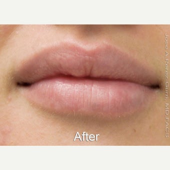 18-24 year old woman treated with Lip Augmentation with Juvederm Ultra XC after 1630783
