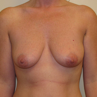25-34 year old woman treated with Breast Lift with Implants before 3003814