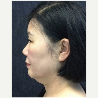 55-64 year old woman treated with Ultherapy before 3179943
