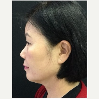 55-64 year old woman treated with Ultherapy after 3179943