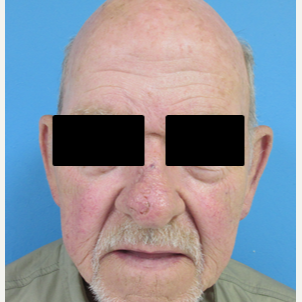65-74 year old man treated with Mohs Surgery after 2788030