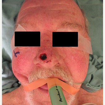 65-74 year old man treated with Mohs Surgery before 2788030
