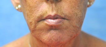 66 Year Old Female Treated for Unacceptable Cosmetic Appearance of the Face after 1075766