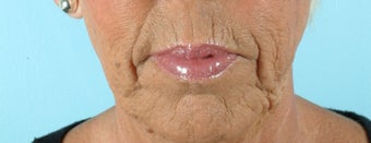 66 Year Old Female Treated for Unacceptable Cosmetic Appearance of the Face before 1075766