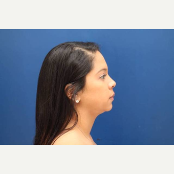 28 year old female treated with 2 sessions of Kybella (4 total vials) before 3814780