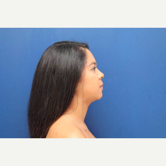 28 year old female treated with 2 sessions of Kybella (4 total vials) after 3814780