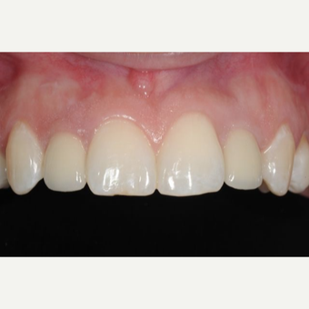 Woman with congenitally missing lateral incisors treated with Dental Implants after 3707957