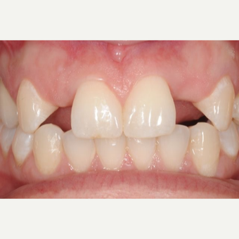 Woman with congenitally missing lateral incisors treated with Dental Implants before 3707957