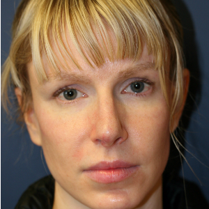 25-34 year old woman treated with Rhinoplasty before 3559790