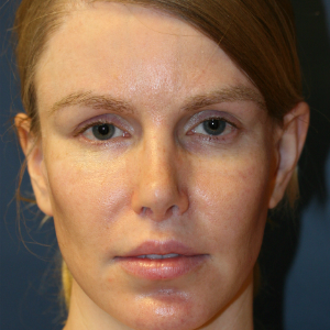 25-34 year old woman treated with Rhinoplasty after 3559790