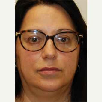 55-64 year old woman treated with Silikon 1000 for Lip Augmentation - Two treatments after 3542349