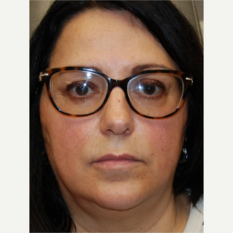 55-64 year old woman treated with Silikon 1000 for Lip Augmentation - Two treatments before 3542349