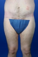 36 Year Old Weight Loss Patient Treated With Medial Thigh Lift after 777486