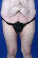 36 Year Old Weight Loss Patient Treated With Medial Thigh Lift before 777486