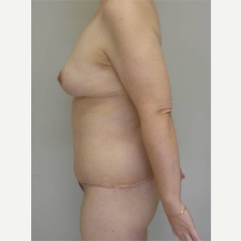 35-44 year old woman treated with Body Lift after 3402363