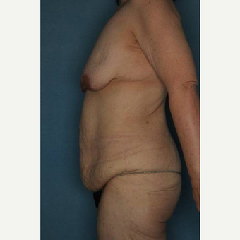 35-44 year old woman treated with Body Lift before 3402363