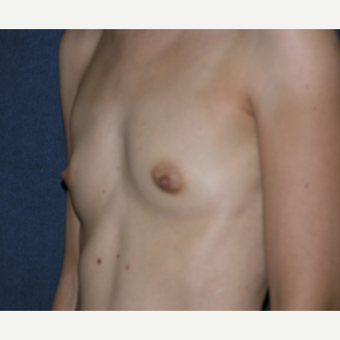35-44 year old woman treated with Breast Augmentation before 3455296