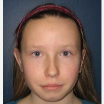 17 or under year old woman treated with Ear Surgery after 3109570