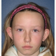 17 or under year old woman treated with Ear Surgery before 3109570