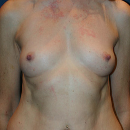 55-64 year old woman treated with Breast Augmentation before 1683584