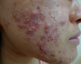 eMatrix for acne and acne scarring before 1522449