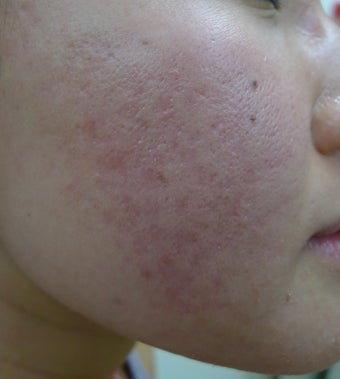 eMatrix for acne and acne scarring after 1522449