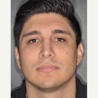 25-34 year old man treated with Rhinoplasty 3 years post-op after 3814038
