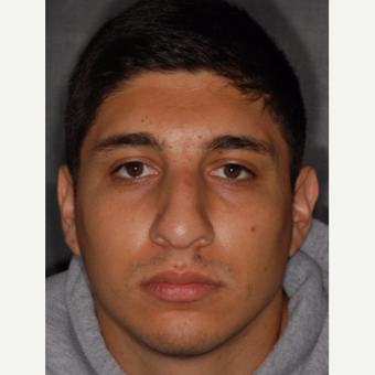 25-34 year old man treated with Rhinoplasty 3 years post-op before 3814038