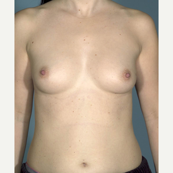 35-44 year old woman treated with Breast Augmentation before 3731679