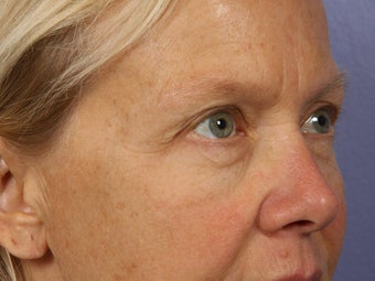 Eyelid Surgery before 280869