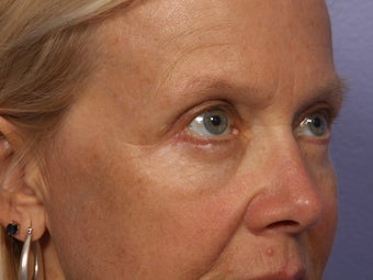 Eyelid Surgery after 280869