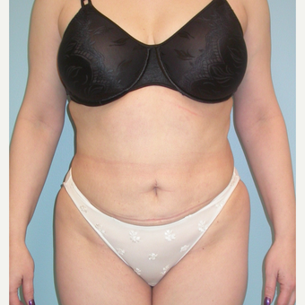 35-44 year old woman treated with Tummy Tuck after 3053539
